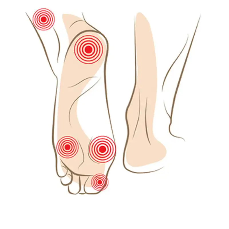 Red marks on a child's foot caused by ill-fitting shoes